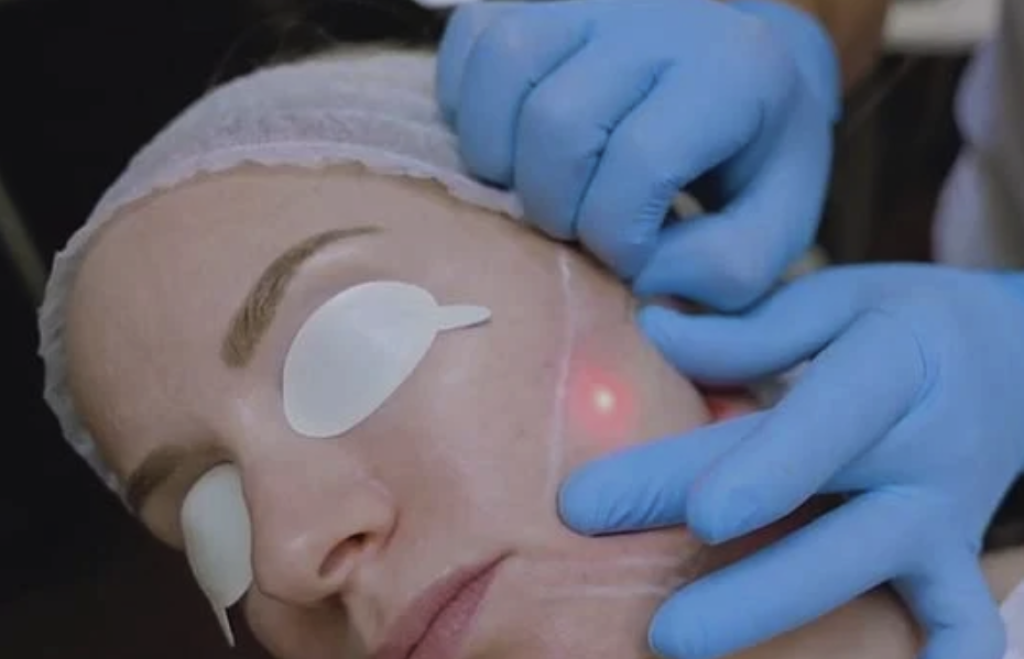 Endolift® Laser-lankahoidon