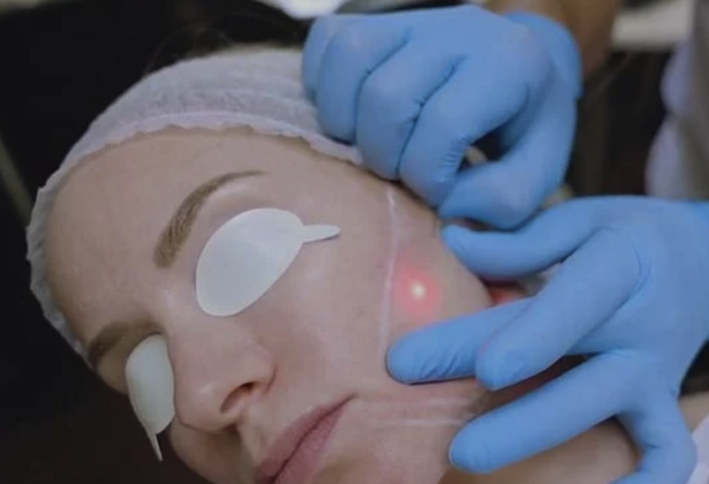 Endolift® Laser-lankahoidon